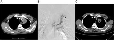 Efficacy and Safety of Drug-Eluting Bead Bronchial Arterial Chemoembolization Plus Anlotinib in Patients With Advanced Non-small-Cell Lung Cancer